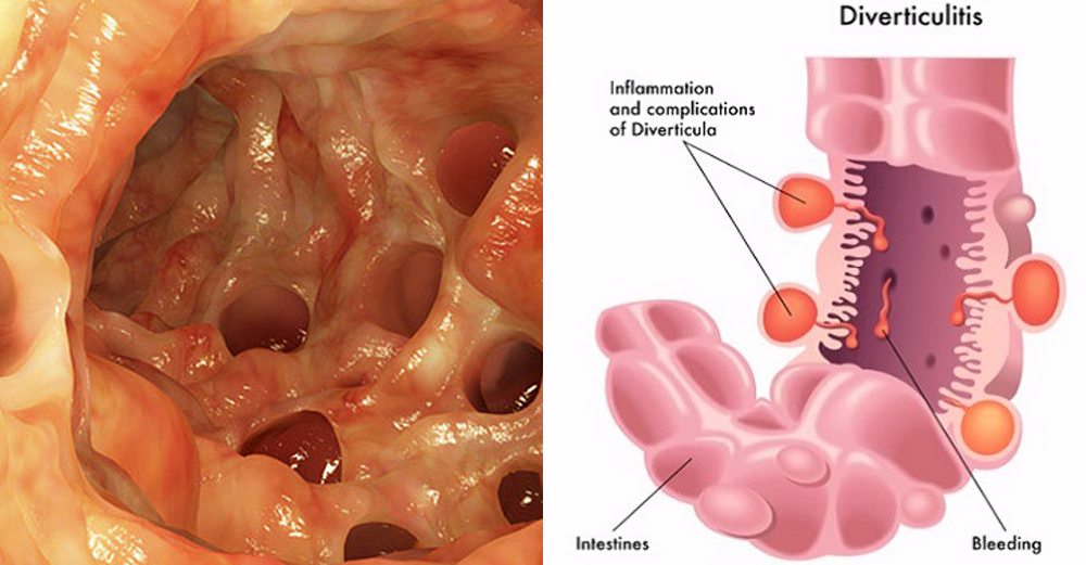 Diverticulitis y ansiedad